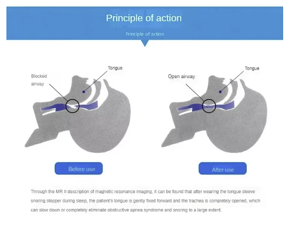 Princple of snoring with mouthpiece to open the trachea airway to slow down or eliminate obstructive apnea