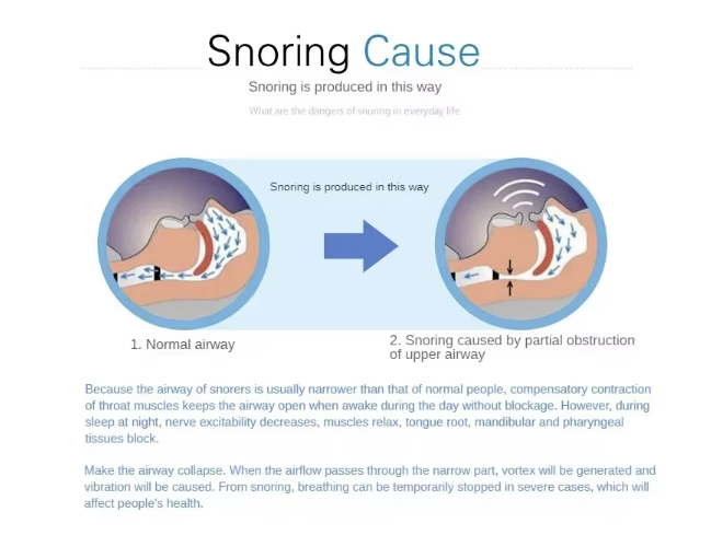 Snoring caused by compensatory muscle contraction obstructed airway